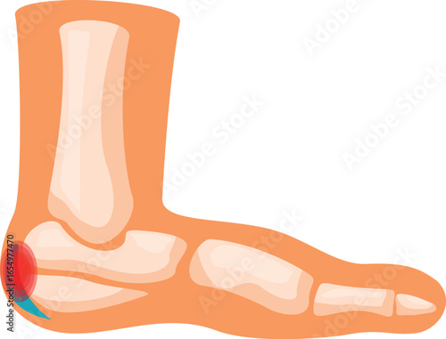 Foot anatomy showing heel pain, inflammation, bones and ligaments, plantar fasciitis concept