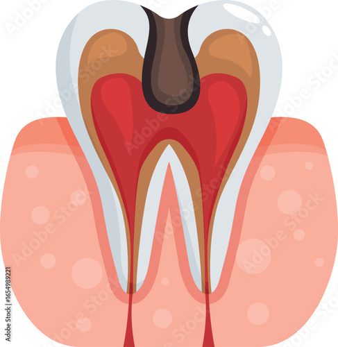 Cross section of molar showing advanced tooth decay affecting pulp and causing inflammation in surrounding gum tissue