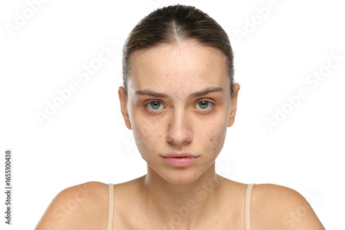 Young woman with acne and bare skin looking at camera, skincare concept, studio shot on white background
