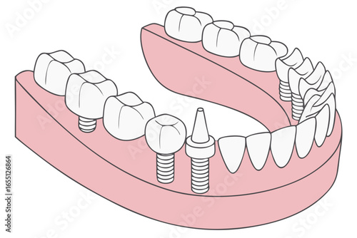 dental implant illustration showing titanium screw and crown in lower jaw anatomy isolated on white background.