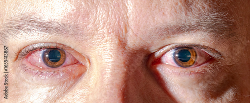 Red inflamed eyes of a man, vessels in the eyes are visible, detachment of the film of the eye. Eye problems, infection, drug exposure, alcohol intoxication.