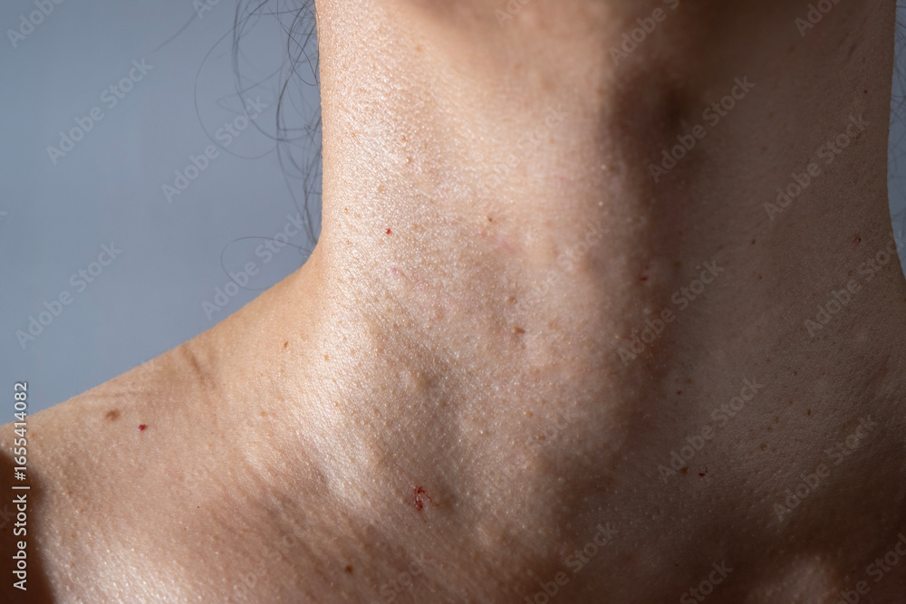 Naklejka premium Woman's skin after subcutaneous injections to smooth out wrinkles.