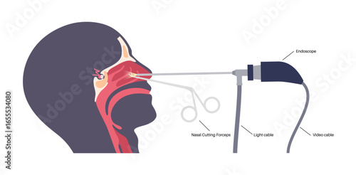 Pituitary gland surgery