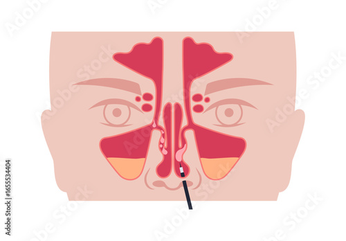 Nasal endoscopy poster
