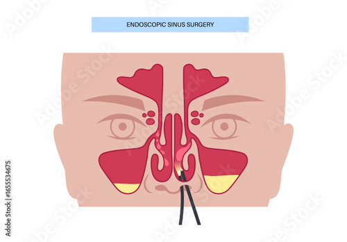 Nasal endoscopy poster