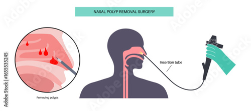 Nasal endoscopy poster