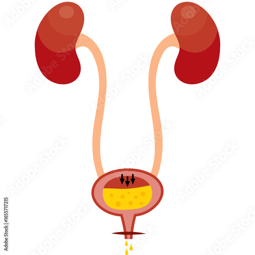 Anatomical diagram of the human urinary system with kidneys and bladder. Medical concept of urinary tract infection or cystitis.