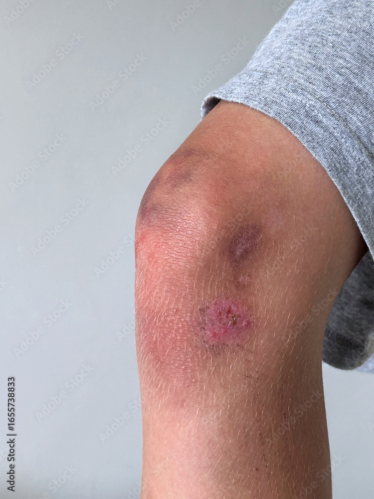 Naklejka premium Bruised and scraped knee with visible abrasions on skin.