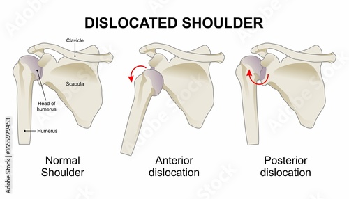 Photos Dislocated shoulder and types of shoulder dislocation