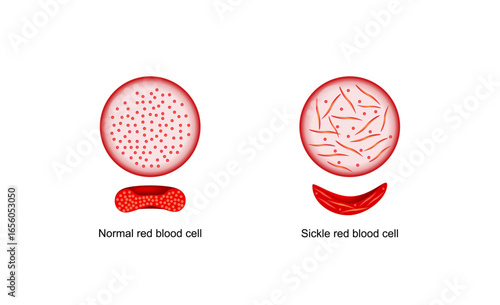 Sickle cell disease. Normal blood cell and Sickle cell. Normal and abnormal hemoglobin. Vector illustration.