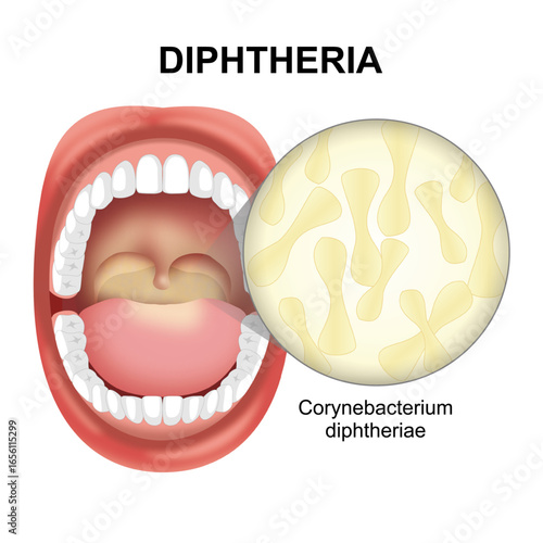 Diphtheria mouth infection illustration, corynebacterium diphtheria