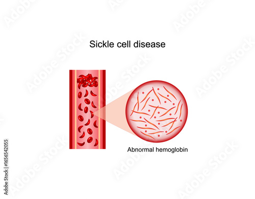 Sickle cell anemia, disease. Sickle cell, abnormal hemoglobin. Gene mutation. Vector illustration.