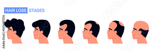 Male hair loss stages from full hair to baldness. Androgenetic alopecia and male pattern baldness progression chart. Isolated vector illustration in cartoon style