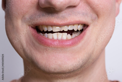 Close up of male smile with chipped, damaged tooth. Concept of dental trauma, dental injury and cosmetic dentistry.