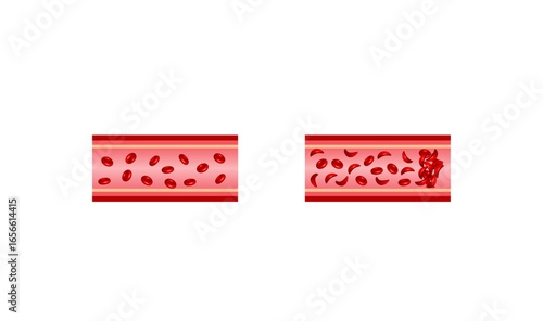 Sickle cell disease. Normal blood and Sickle cell anemia. Gene mutation. Vector illustration.	