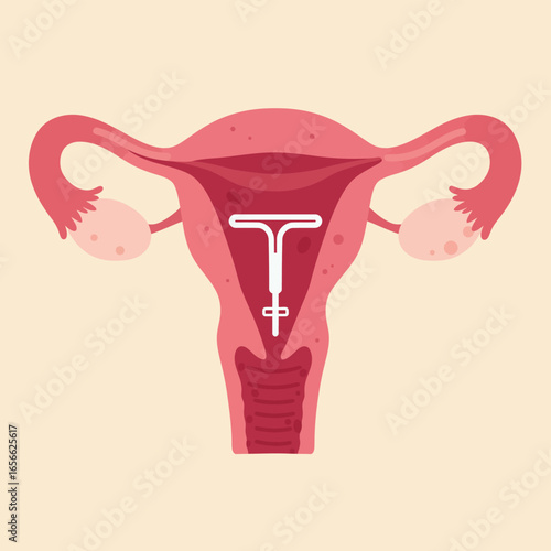 Illustration of Uterus with Intrauterine Device IUD