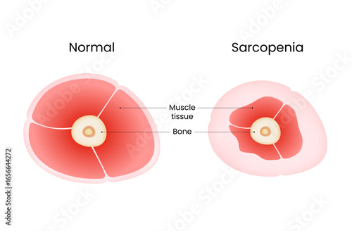 Comparison of Normal Muscle and Sarcopenia in Cross Section