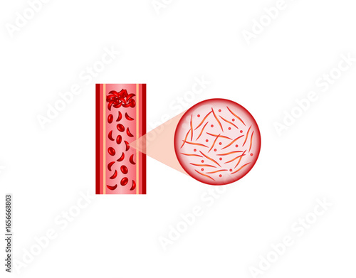 Sickle cell disease. Normal blood and Sickle cell anemia. Gene mutation. Vector illustration.	