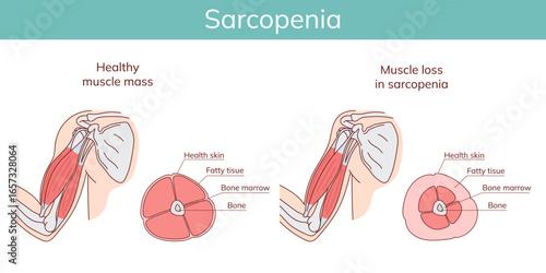 Sarcopenia. Loss of muscle mass.Vector anatomical illustration