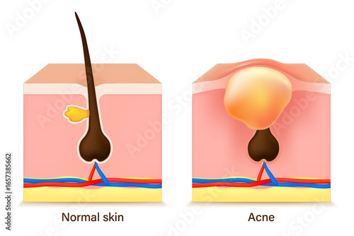 Acne skin. Comparison of normal skin and acne. Facial skin problems. Vector for advertising about beauty and medical treatment.