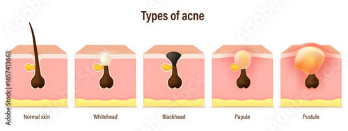 Types of acne skin vector. Blackheads, Whiteheads, Papules and Pustules. Facial skin problems. Vector for advertising about beauty and medical treatment.