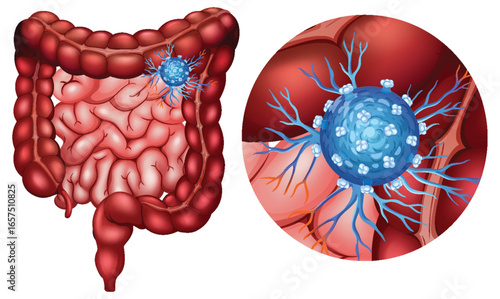 Detailed Colon Anatomy with Cancer Cell Illustration