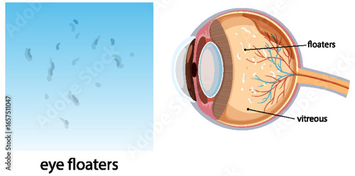 Medical Diagram of Eye Floaters and Vitreous Anatomy