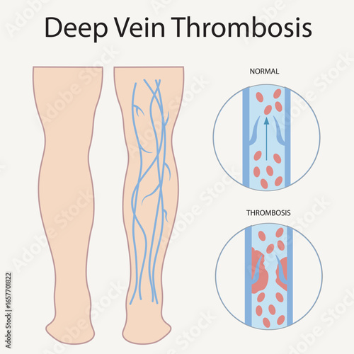 Deep vein thrombosis vector: shows leg swelling, pain, warmth, redness, vein tenderness; highlights risk of pulmonary embolism and similarities to varicose veins and cellulitis.