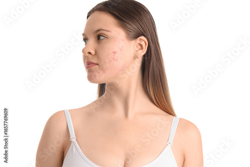 Teenage girl with acne prob...
