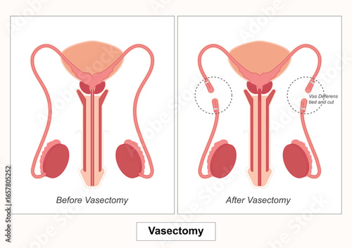 Vasectomy is a surgical procedure for permanent contraception in men involving cutting.