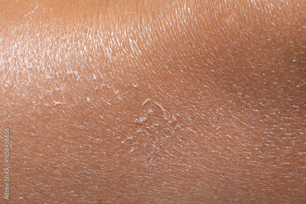 Fototapeta premium Close-up of dry and peeling skin showing severe dehydration