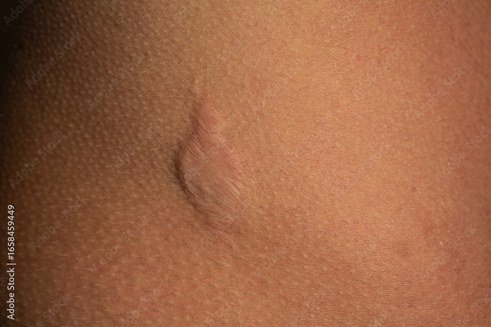 Fototapeta premium Large scar healing on skin after surgery or trauma