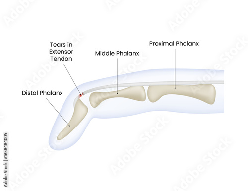 Finger Anatomy Showing Extensor Tendon Tears