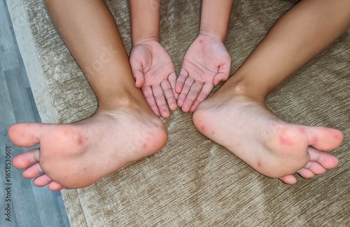 Enterovirus.Koksaki.Kid with spots on arms and feet