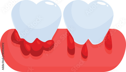 Periodontal disease causing bleeding gums and gingivitis