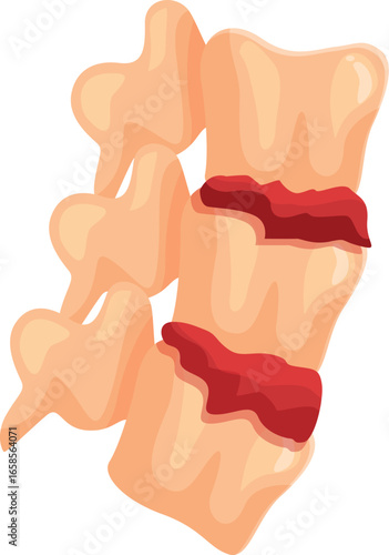 Herniated disc causing spinal cord damage, medical illustration showing injury