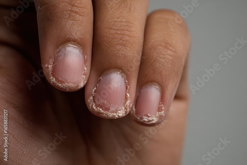 Common nail disorders encountered in clinical practice include brittle nail syndrome onychomycosis paronychia nail psoriasis longitudinal melanonychia Beau s lines onychomadesis and r
