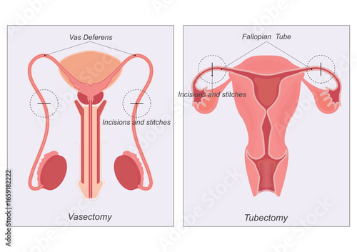 Sterilization is any of several medical methods of permanent birth control .