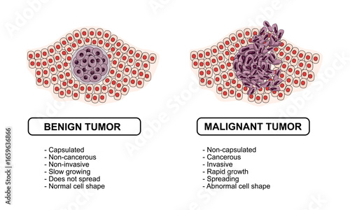 Vector illustration of malignant and benign tumors in body tissues. Difference between malignant and benign tumors, Spread of cancer cells. Medical vector illustration for education, posters, clinics,