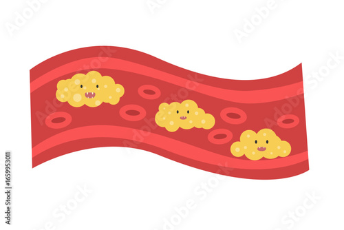 Cholesterol Buildup in Blood Vessel