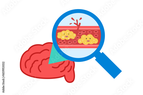 Cholesterol Buildup in Blood Vessel