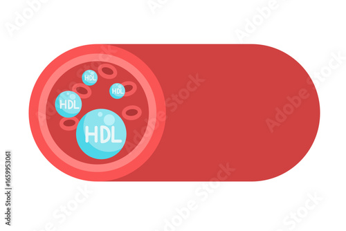 Cholesterol Buildup in Blood Vessel