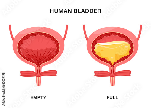Empty and full urinary bladder, human bladder anatomy. Vector illustration.