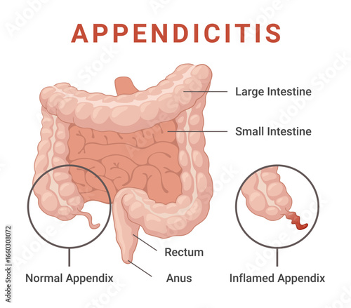 Illustration of an inflamed appendix as seen in appendicitis, showing its location in the human digestive system, as well as an image of a normal appendix.