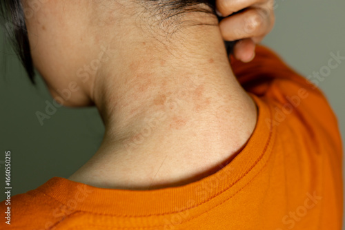 A close up of the neck showing Red patches reddish skin inflammation irritation or rash on the skin indicating possible allergy or eczema.