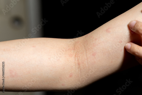 A close up of the arm showing Red patches reddish skin inflammation irritation or rash on the skin indicating possible allergy or eczema.