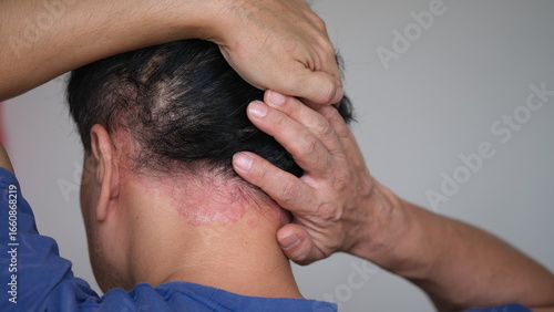 фотографія Psoriasis on the nape of a man. Skin with psoriasis.