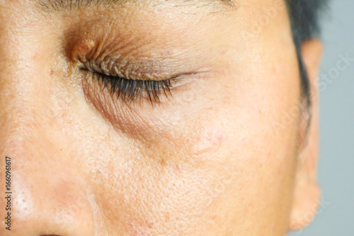 The right male eye of a man with drooping eyelid, vitiligo and xanthelasma. Cosmetic treatment of skin defects
