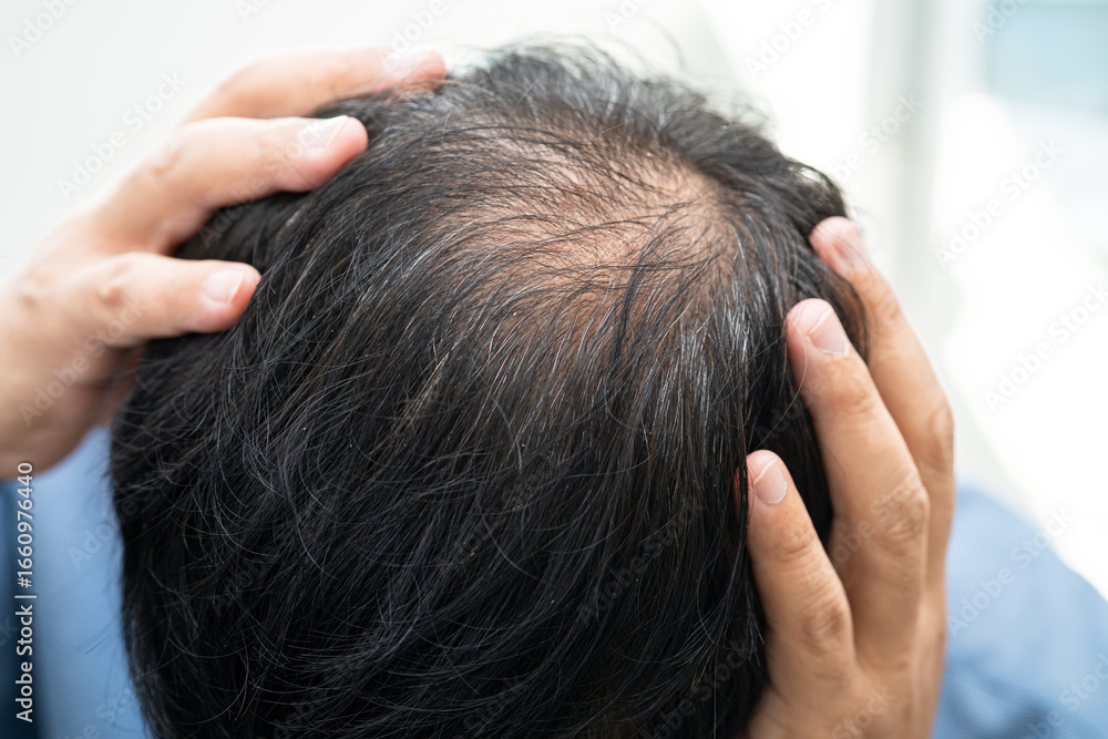 Fototapeta premium Bald in the middle head and begin no loss hair glabrous of mature Asian business smart active office man.