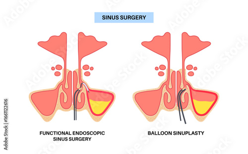 Minimally invasive endoscopic procedures